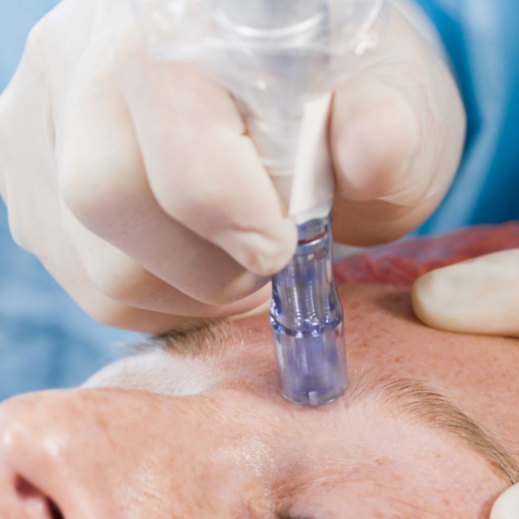 aghi per microneedling e per la bioinduzione di collagene